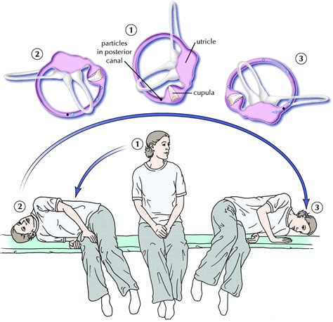 Epley And Semont Maneuvers For Vertigo Wheretolf