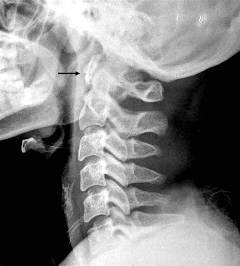 Lateral Radiograph Of Cervical Spine Shows A Well Corticated Bone SexiezPicz Web Porn