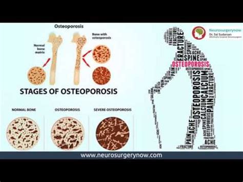Bone density tests are a quick and painless procedure. Low Bone Density Treatment Hyderabad | Osteoporosis ...