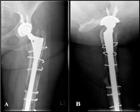 Figure 1 From Modified Extended Trochanteric Osteotomy With