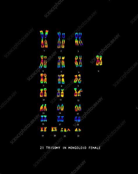 female karyotype showing down s syndrome stock image c022 0534 science photo library