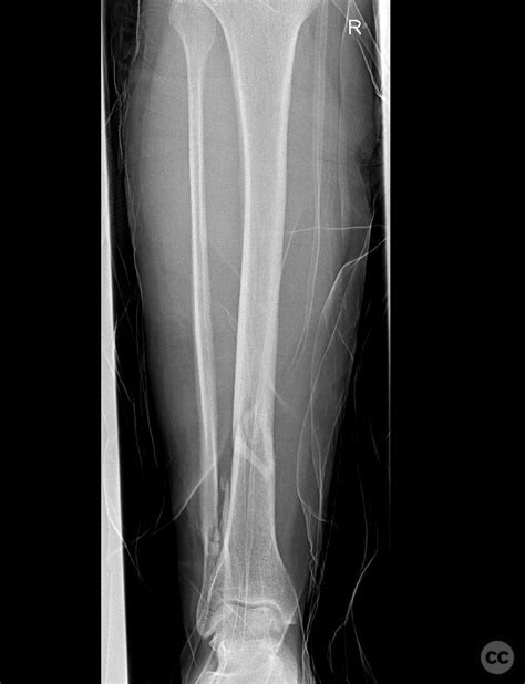 Distal 13 Tibia Shaft Fracture With Distal Fibular Fracture