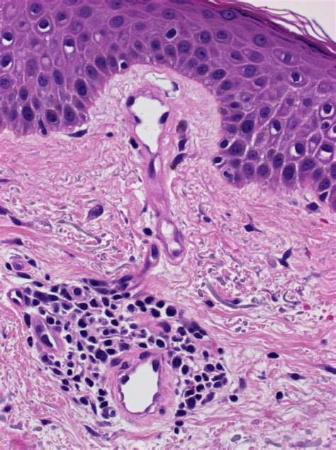 Pathology Outlines Pigmented Purpuric Dermatosis