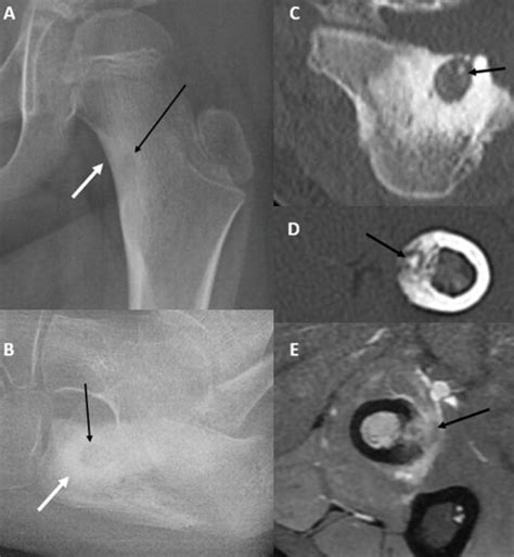 Imaging Of Pediatric Benign Bone Tumors Intechopen