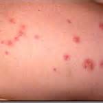 Pictures of Treatment For Bed Bugs Rash