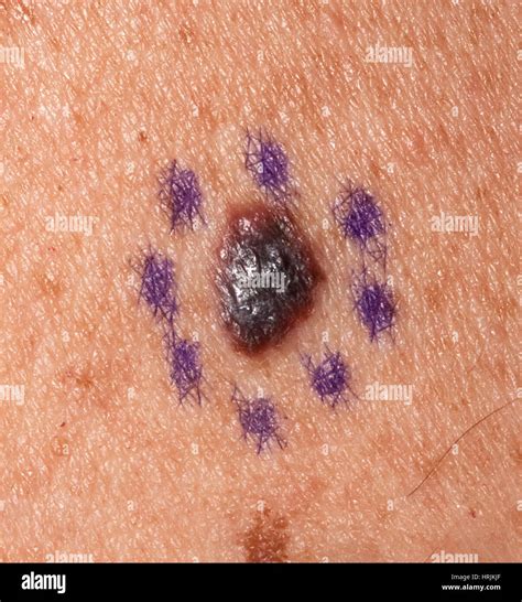 Skin Cancer Malignant Melanoma Stock Photo Alamy