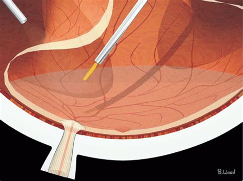 Vitrectomy For Retinal Detachment Ento Key