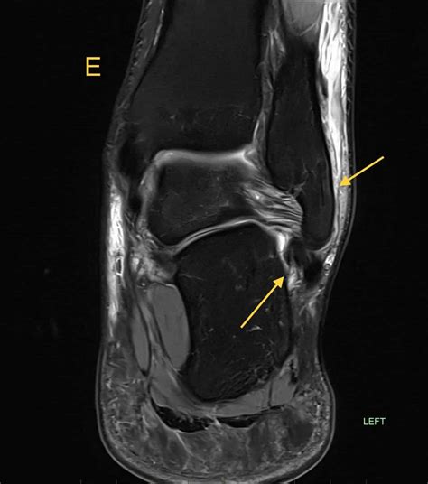 Peroneal Tendon Injuries A Commonly Overlooked Cause Of Chronic Ankle