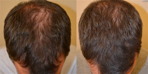 Can women use dutasteride for acne and hair loss? Propecia before and after photos - Dr Rogers - New Orleans