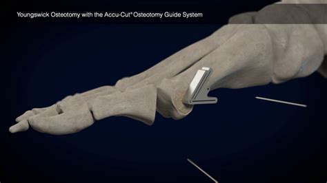 Youngswick Animation With Accu Cut Osteotomy Guide Youtube