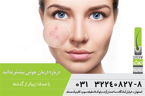 انواع جای جوش و درمان آنها کلینیک تخصصی پوست صدف در اصفهان