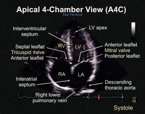 What are the four chambers of the heart are called? Apical 4 Chamber View TEE | Cardiac sonography, Diagnostic ...