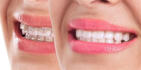 Can You Whiten Teeth With Braces A Comprehensive Guide Bm