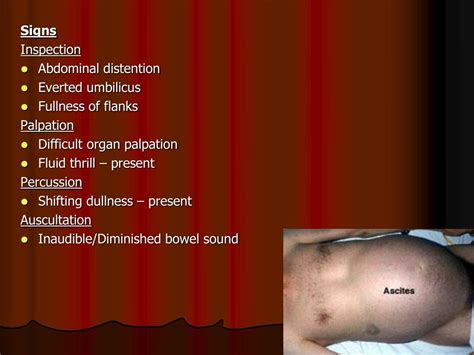 Cureus An Unusual Cause Of Ascites In Liver Cirrhosis