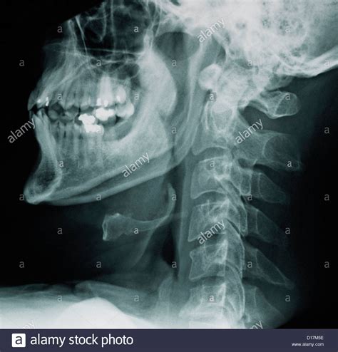 Cervical Spine X Rays Normal Stock Photo Alamy