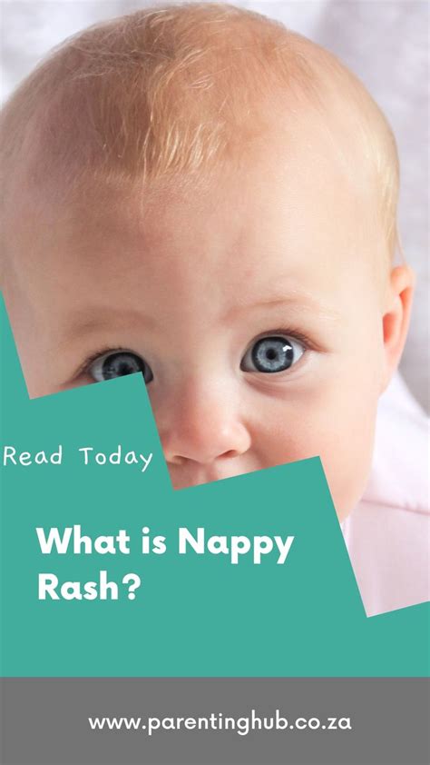 Nappy Rash Refers To A Diffuse Rash On The Area Of Skin That Is Covered