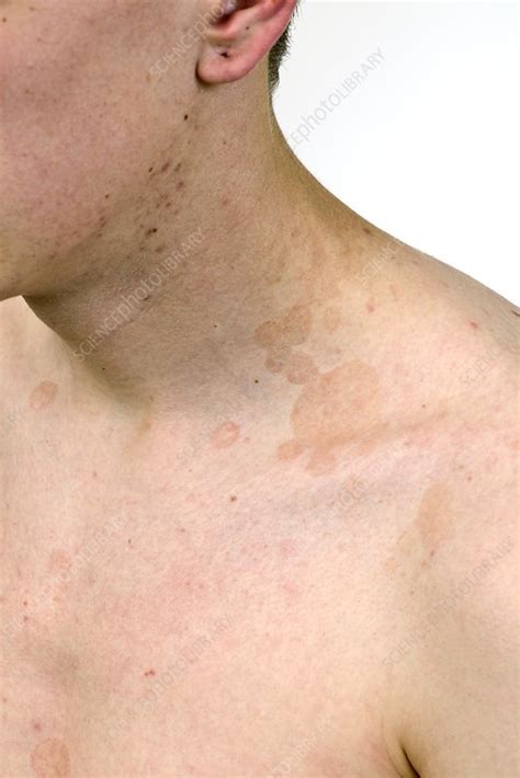 Tinea Pityriasis Versicolor