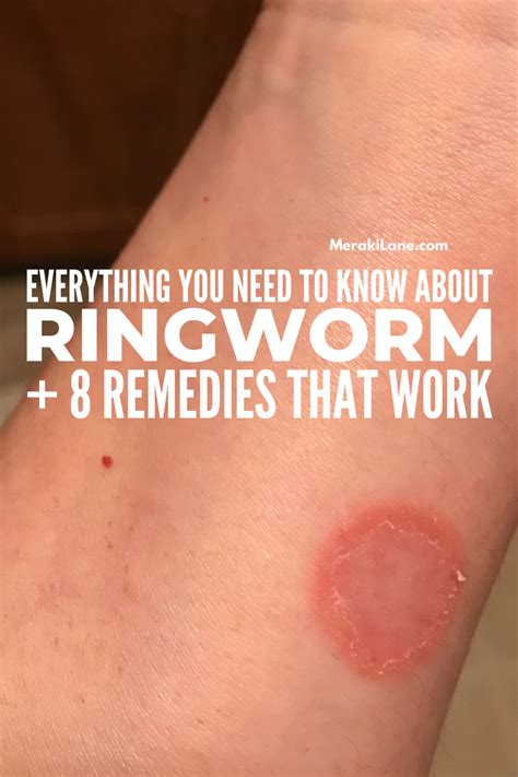 How To Get Rid Of Ringworms Artofit