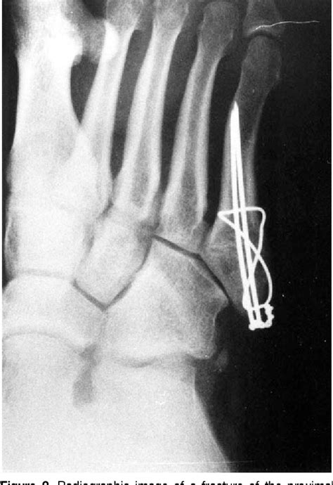 Figure 2 From Tension Band Wiring For Fractures Of The Fifth Metatarsal Located In The Junction