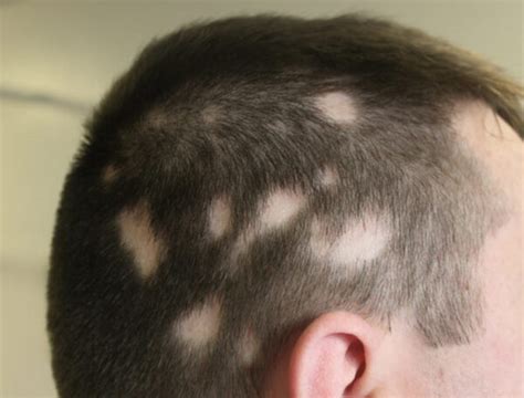 Scalp Hair Problems Faciem Dermatology Clinic
