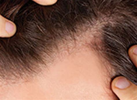 SAÇ DÖKÜLMESİNE ÇÖZÜM, NE İYİ GELİR? - Clinichair Saç Ekimi izmir