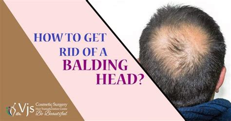 How To Get Rid Of Baldness Head Know Causes And Treatments