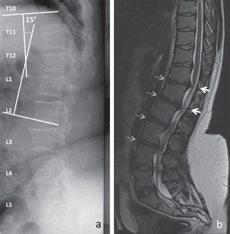 Achondroplasia X Ray