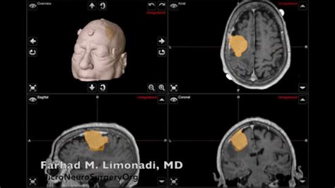 Brain Surgery Removal Of Large Brain Tumor Meningioma Youtube