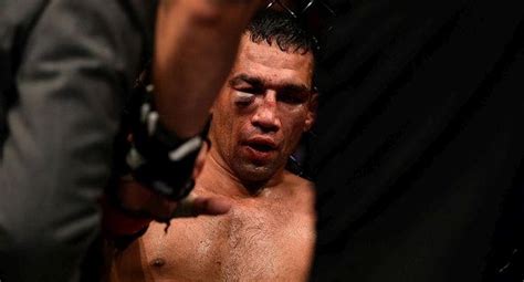 UFC Fabricio Werdum Y El Terrible Estado De Su Cara Tras Perder Ante