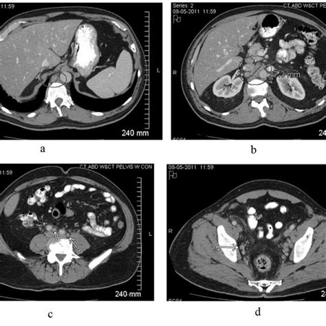 Contrast Enhanced Ct Scan Of The Abdomen And Pelvis Reveals