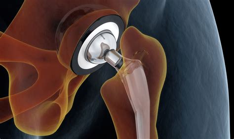 What Is The Rehab For A Hip Replacement