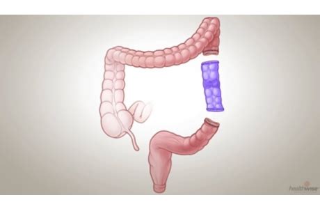 Bowel Resection Video Image