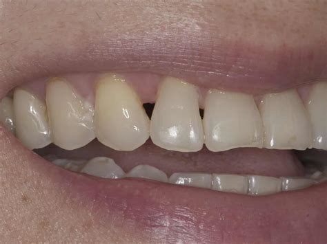 Lake Forest Dentist Treats Black Dental Triangles