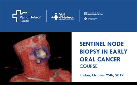 Sentinel Node Biopsy In Early Oral Cancer Secomnor