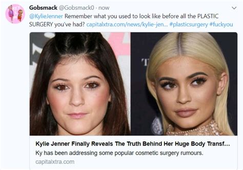 Kylie Jenner Before and After Years of Plastic Surgery ...