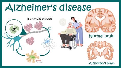 Alzheimers Disease Plaques Tangles Causes Symptoms Pathology And