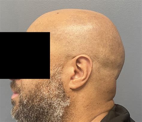Plastic Surgery Case Study Male Occipital Bun Reduction By A High