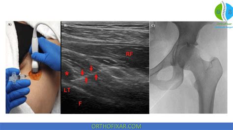 Iliopsoas Bursitis Injection