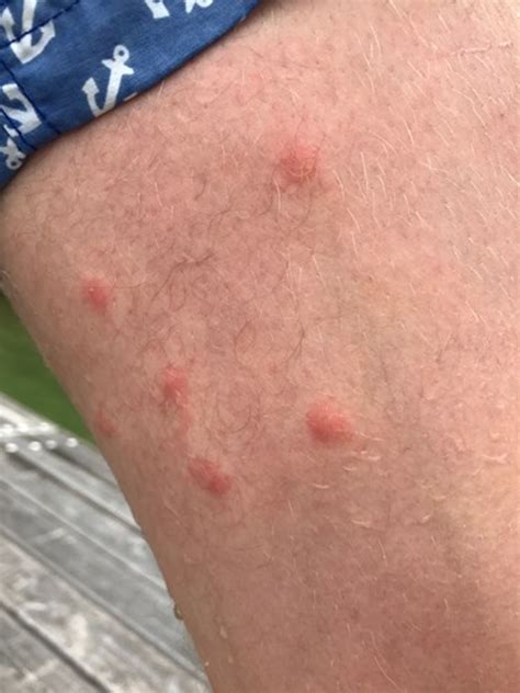 Swimmers Itch & Cercarial Dermatitis - Causes, Prevention, Treatment