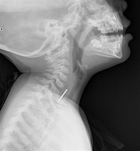 Swallowed Coin Lateral View Buyxraysonline