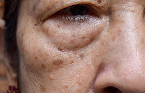 Age Spots Vs Freckles Whats The Difference And Treatments 2022