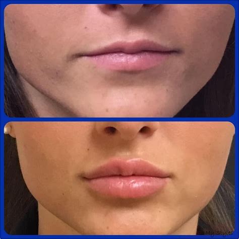 When Does Juvederm Take Full Effect