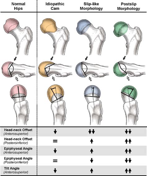 Morphologic Features Of The Proximal Femur For The Four Study Groups