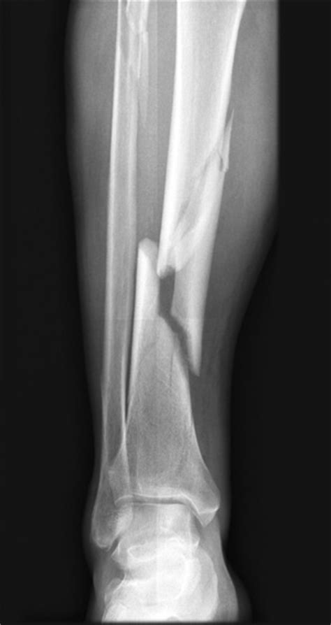 Compartment Syndrome Following Tibia Fracture Lower Extremity Review
