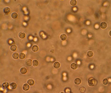Pus Cells In Urine Normal Range Hpf For Babies