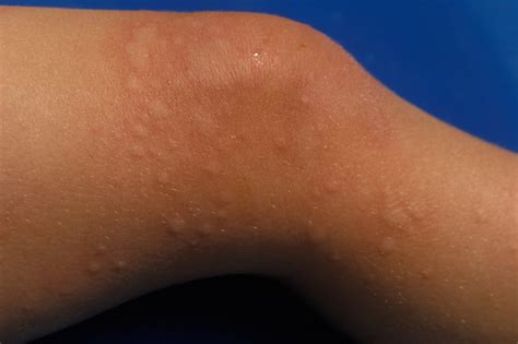 Skin Rashes On Toddlers
