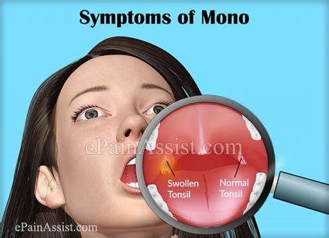 A Guide On Early Symptoms Of Mono Signs Of Mononucleosis In Adults And