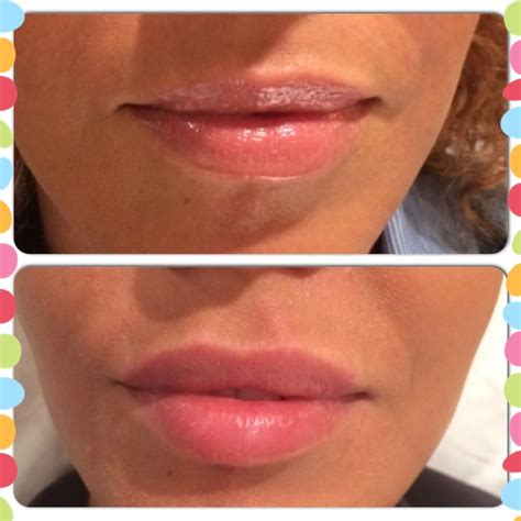 Lips Before And After 1 Syringe Of Juvederm Yelp
