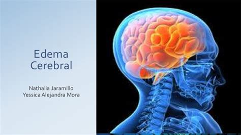 Cerebral Edema Cartoon