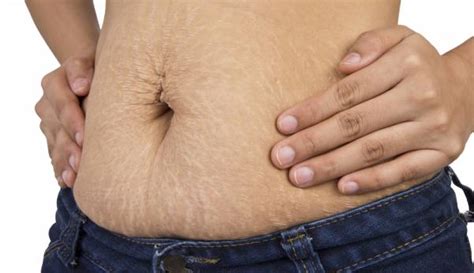 Stretch marks occur when the body undergoes some sort of rapid growth — like pregnancy, puberty, or weight gain — that can pull on your skin and well, stretch marks can definitely reveal damaged tissue — they might look kind of veiny, or like the bare branches of a tree. The Reality of Stretch Marks: My Body Will Never Be the ...